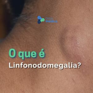 linfonodomegalia o que é